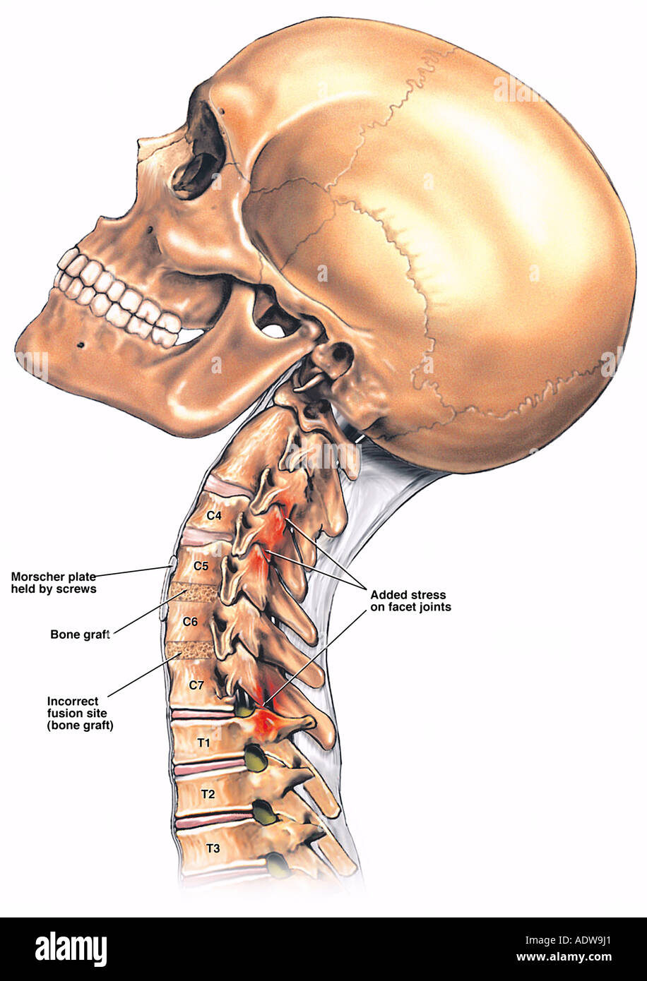 Neck Fusion Hi res Stock Photography And Images Alamy