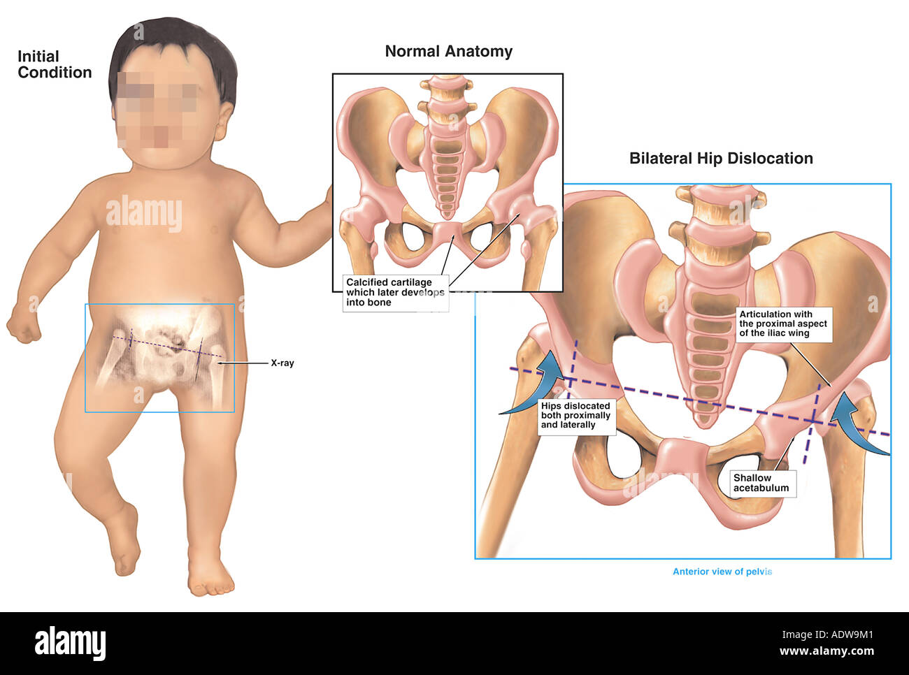 hip dislocation in babies