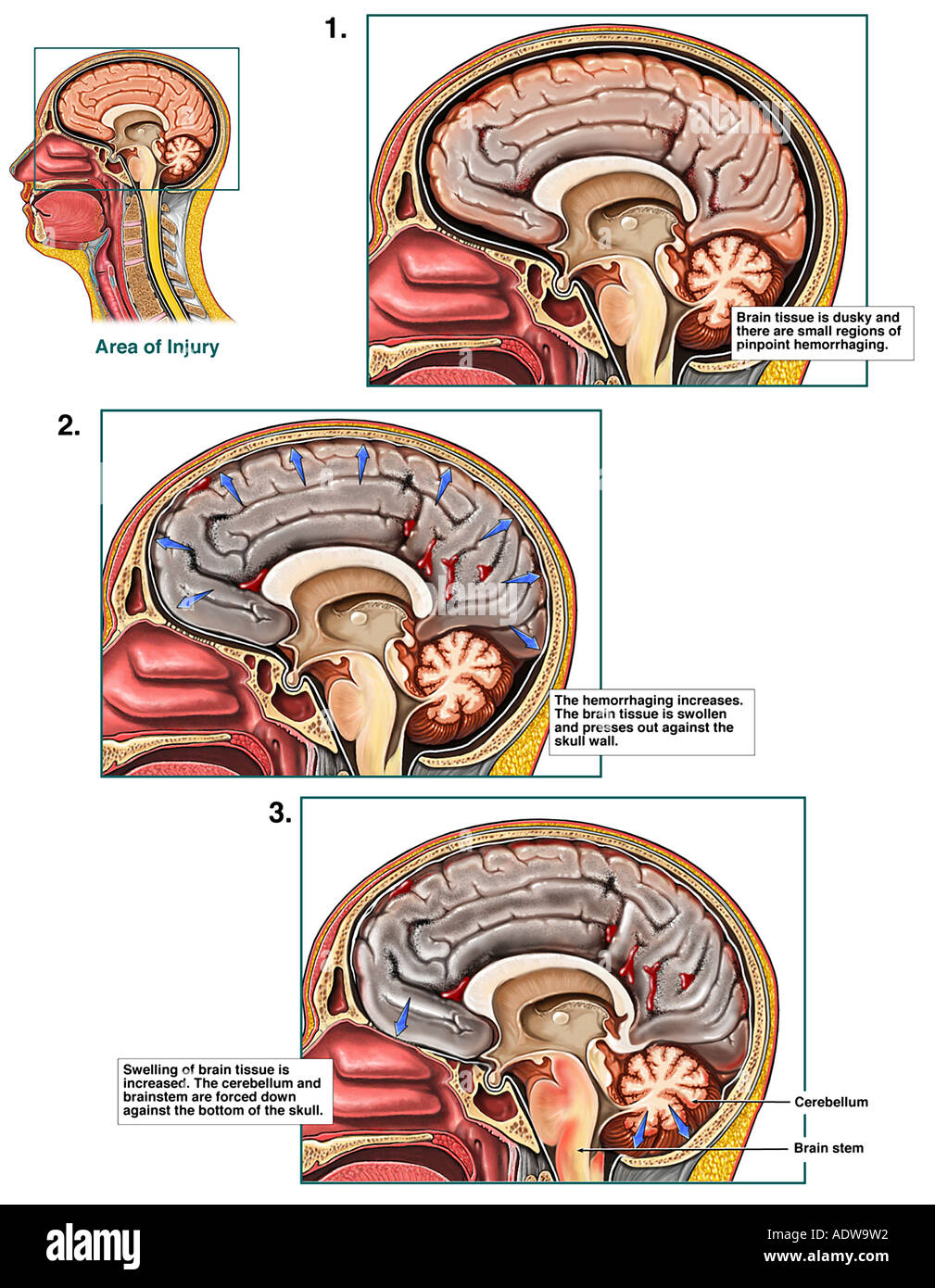 Lack of oxygen to brain hires stock photography and images Alamy