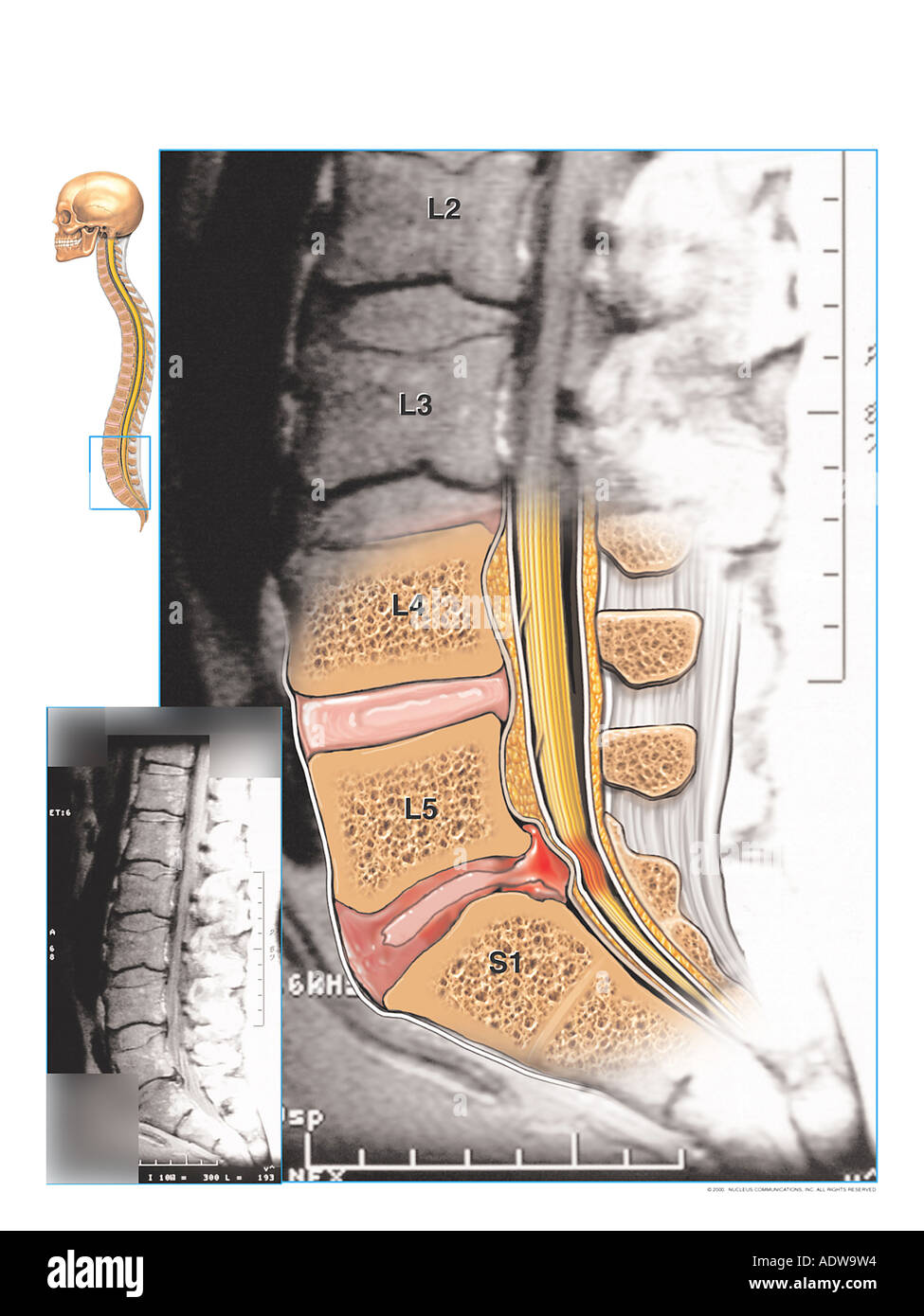 Radiografia Hernia Lumbar