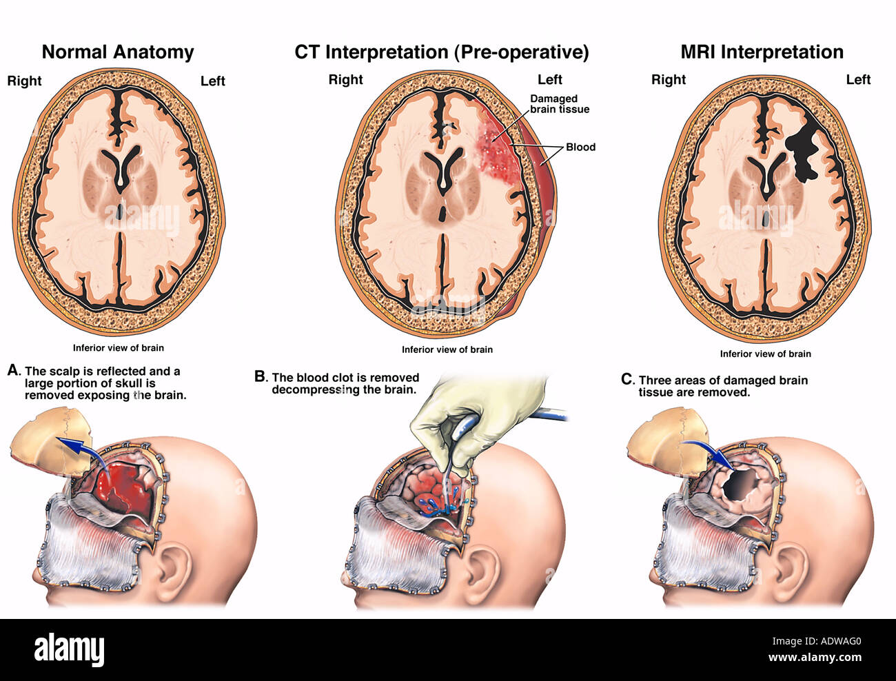 Brain Surgery Post Accident Injuries With Surgical Drainage And Repair Stock Photo Alamy