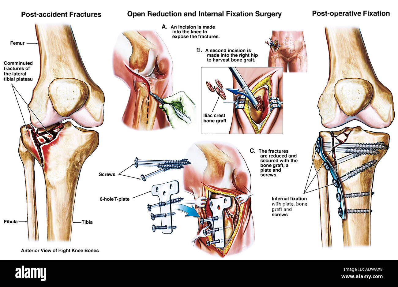 Tibial Plateau Fracture With Fixation Stock Photo 7713063