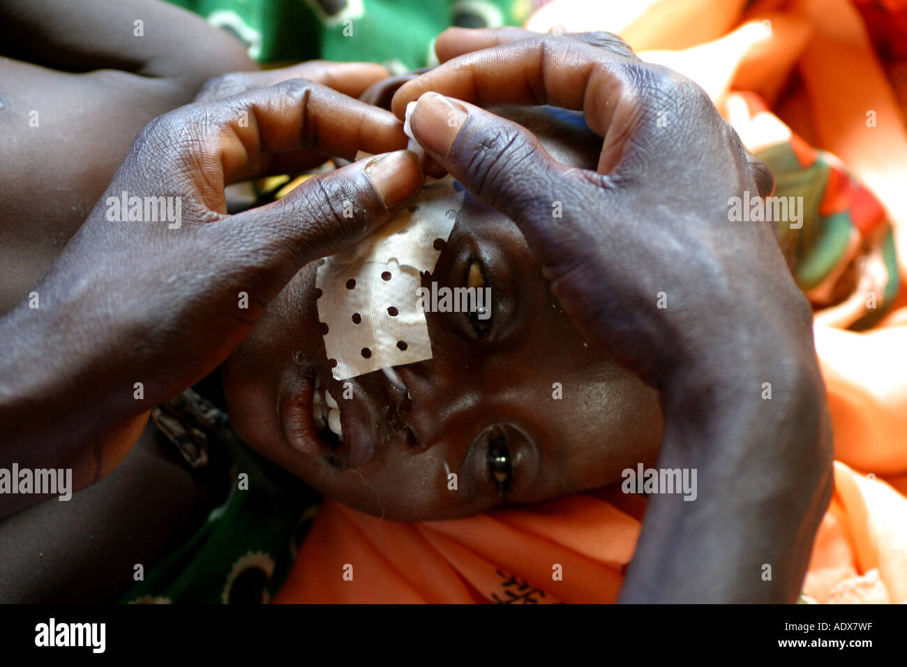 Malnourished child in MSF clinic in Kalma camp Nyala town Darfur Stock Photo