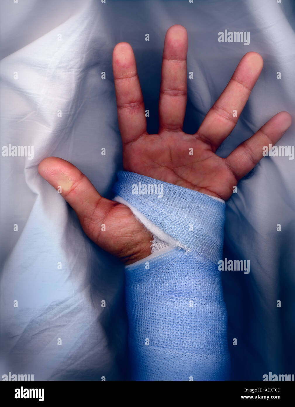 Color Studio shot of a fractured wrist in a fiberglass cast Stock Photo