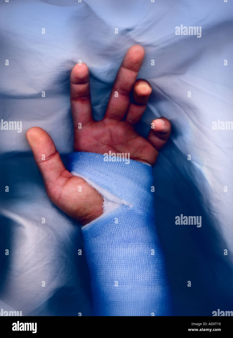 Hand in Cast on White Background Stock Image - Image of fiberglass, hurt:  167244825