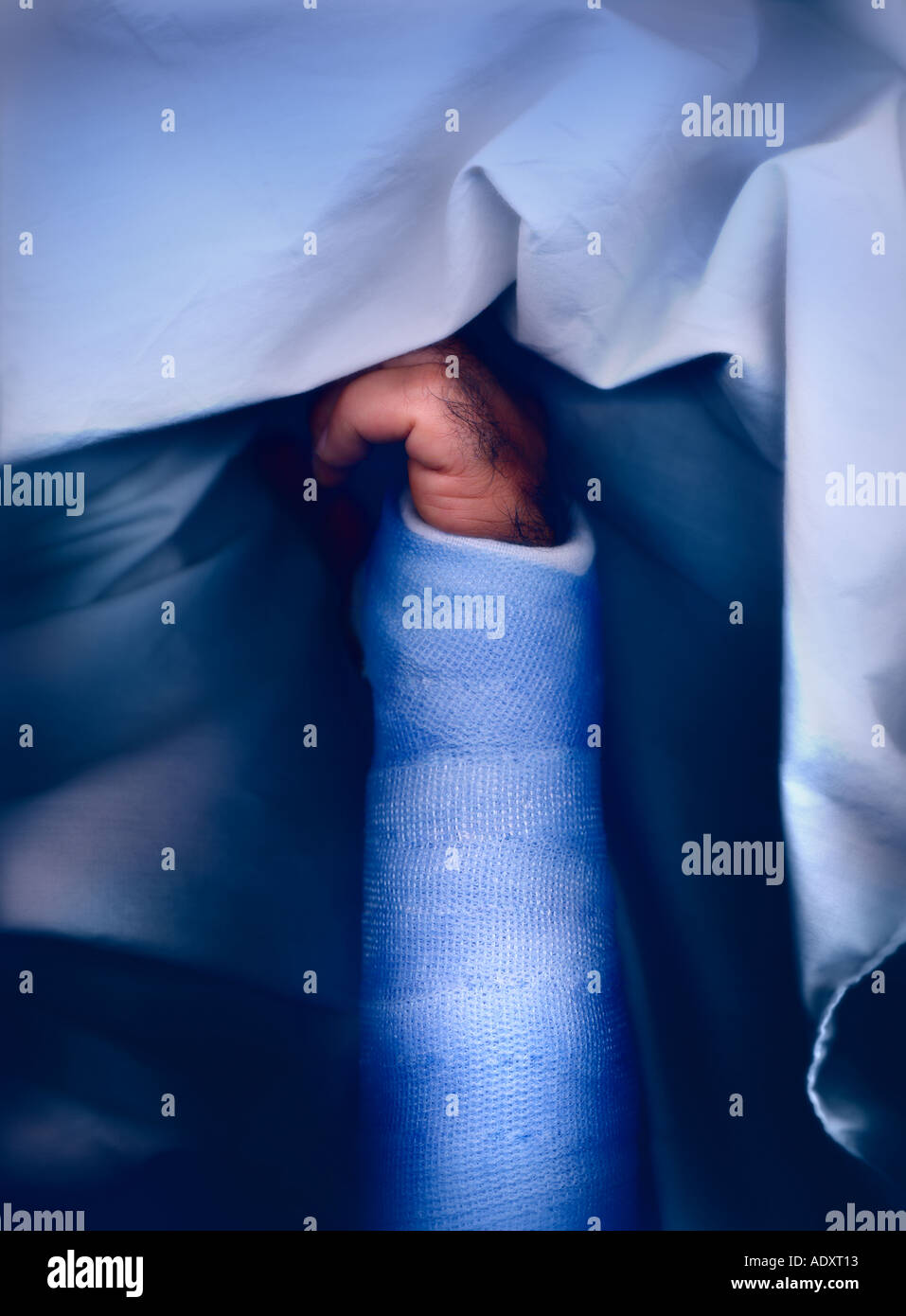 Fractured wrist in a fiberglass cast Stock Photo Alamy