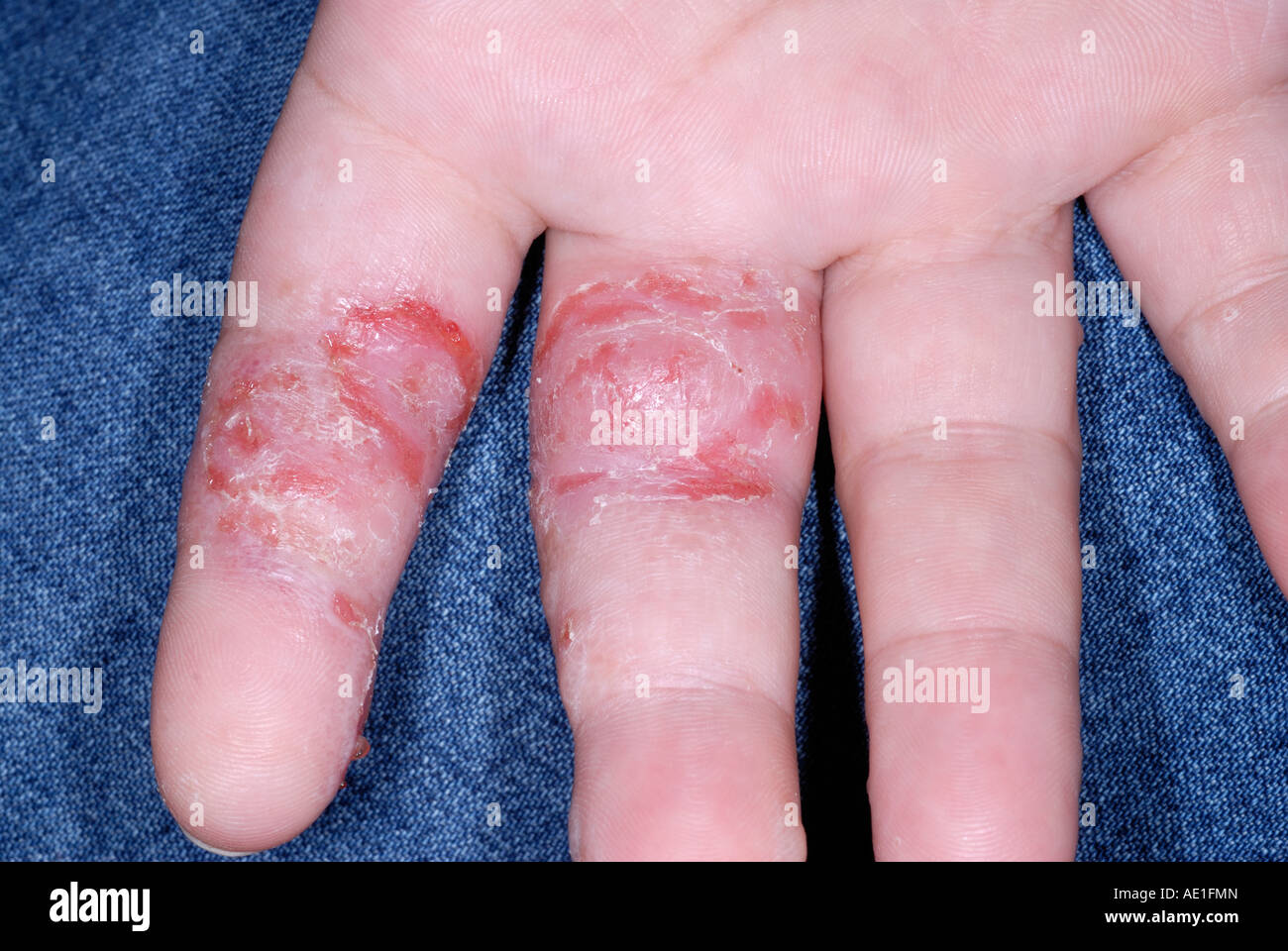 Dyshidrotic eczema on the hand of a 34 year old female Stock Photo