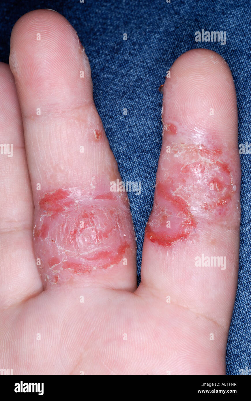 Dyshidrotic eczema on the hand of a 34 year old female Stock Photo