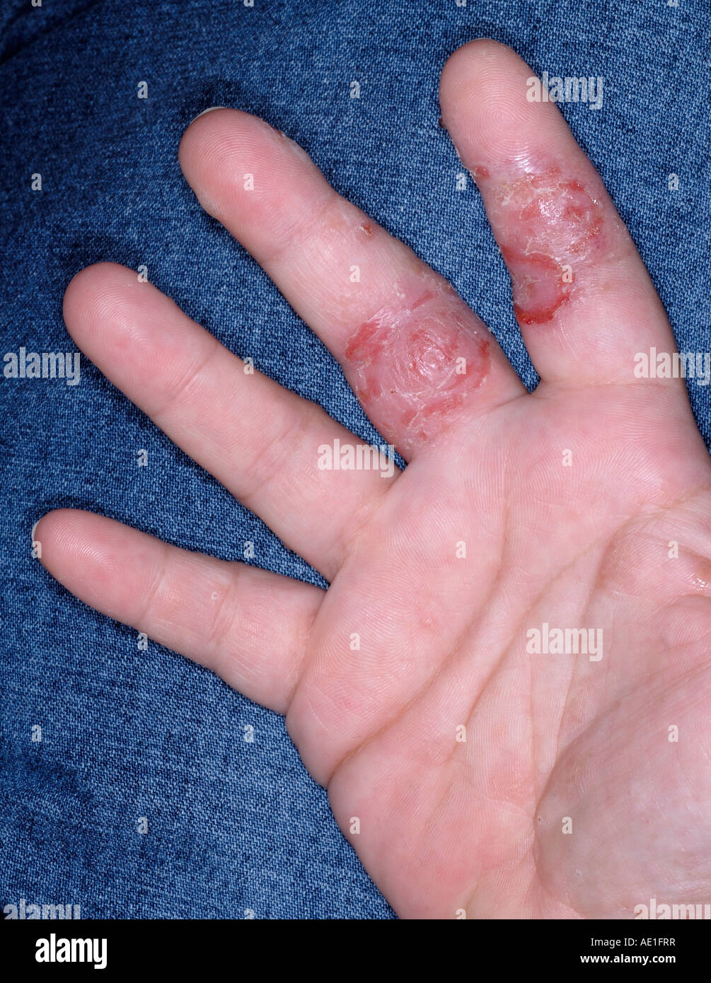 Dyshidrotic eczema on the hand of a 34 year old female Stock Photo