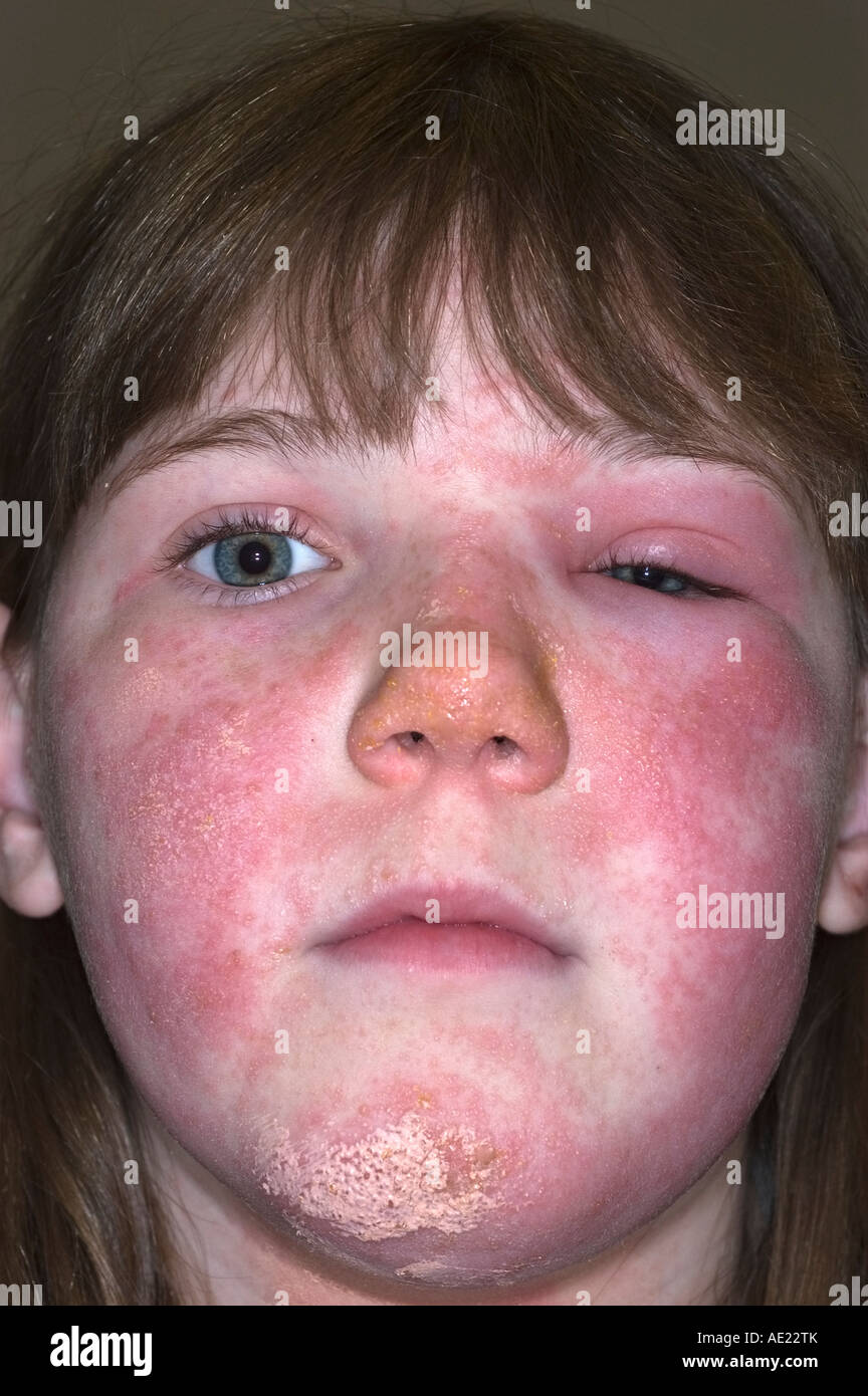 young girl with poison ivy rash on her face which she is treating with calamine lotion Stock Photo