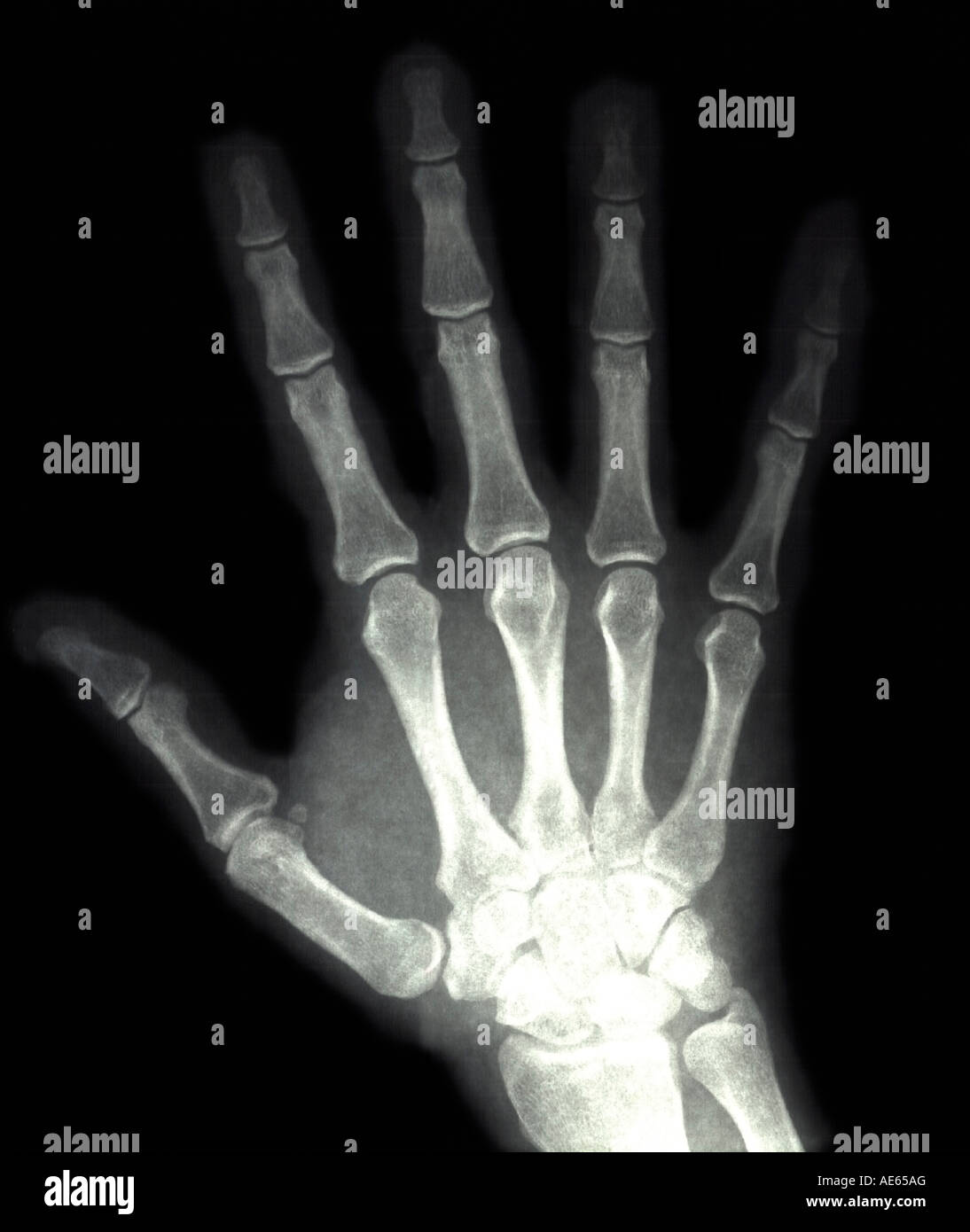 Conventional film based radiograph or xray of a human hand showing the