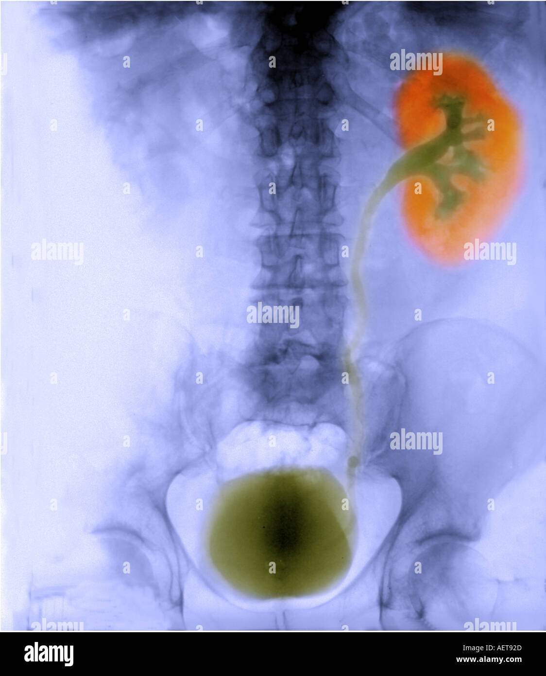 color enhanced xray showing the kidney and bladder Stock Photo