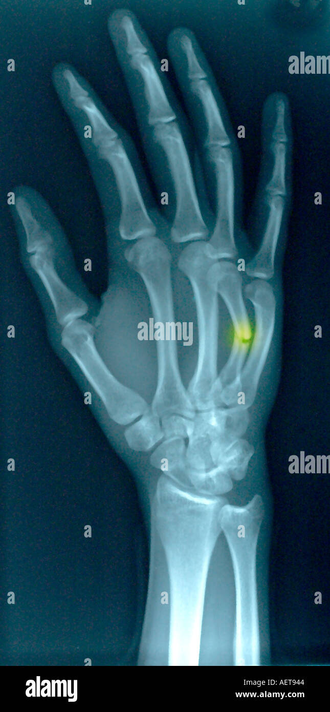fractured 4rth metacarpal of the hand Stock Photo