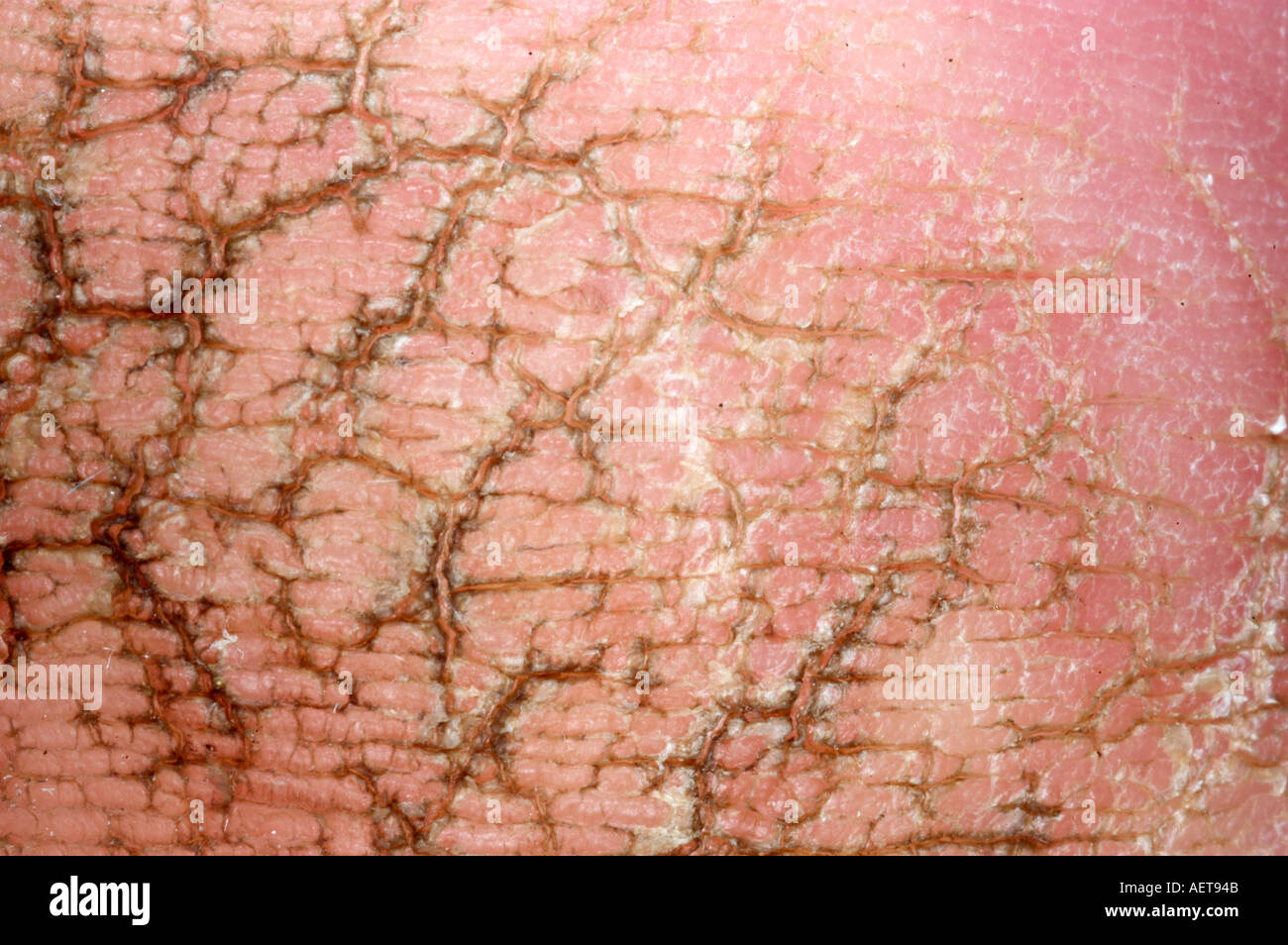 Calloused fissured skin on the heel of the foot Stock Photo - Alamy