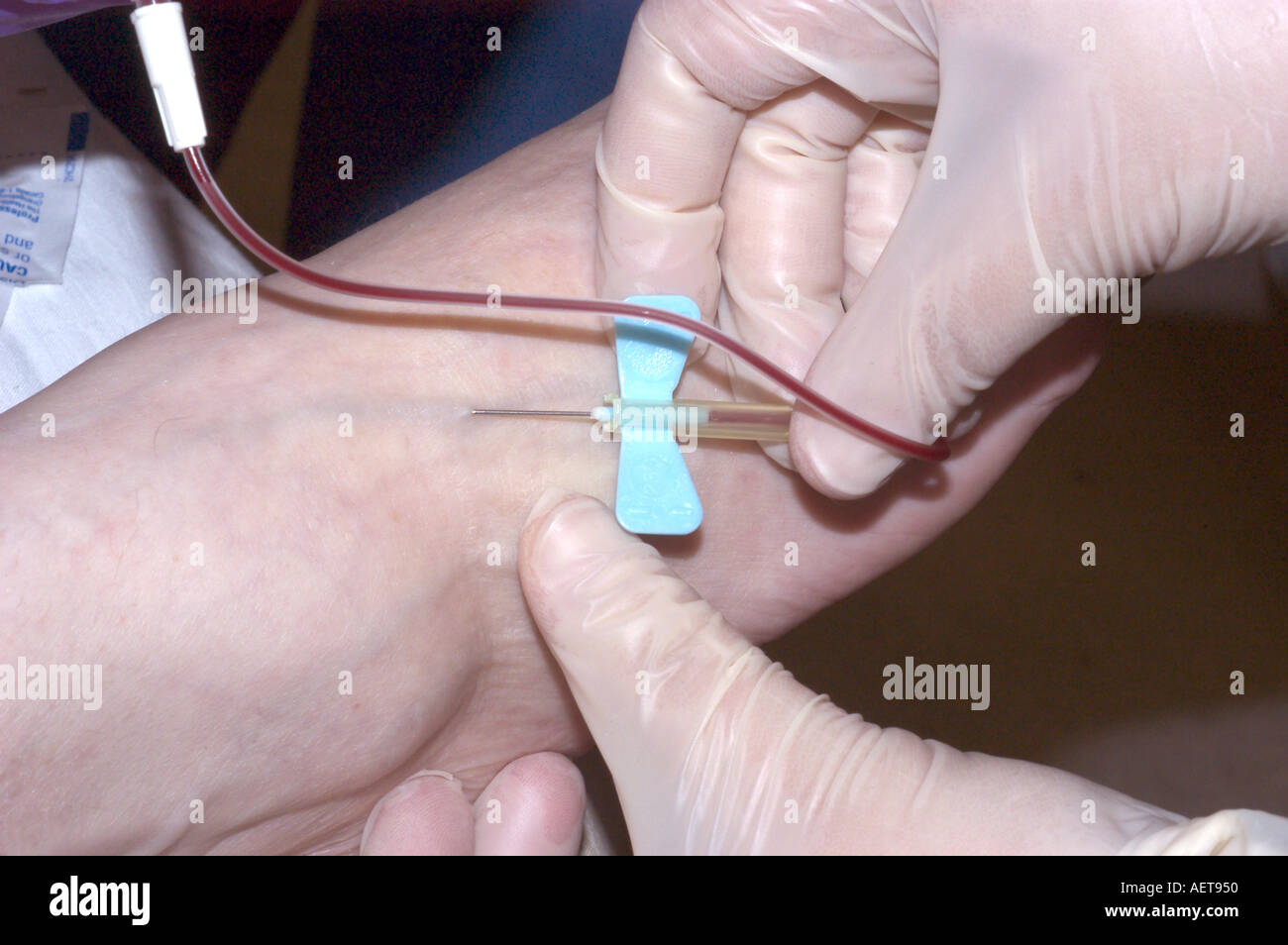 Nurse inserting butterfly catheter in a vein to give a patient
