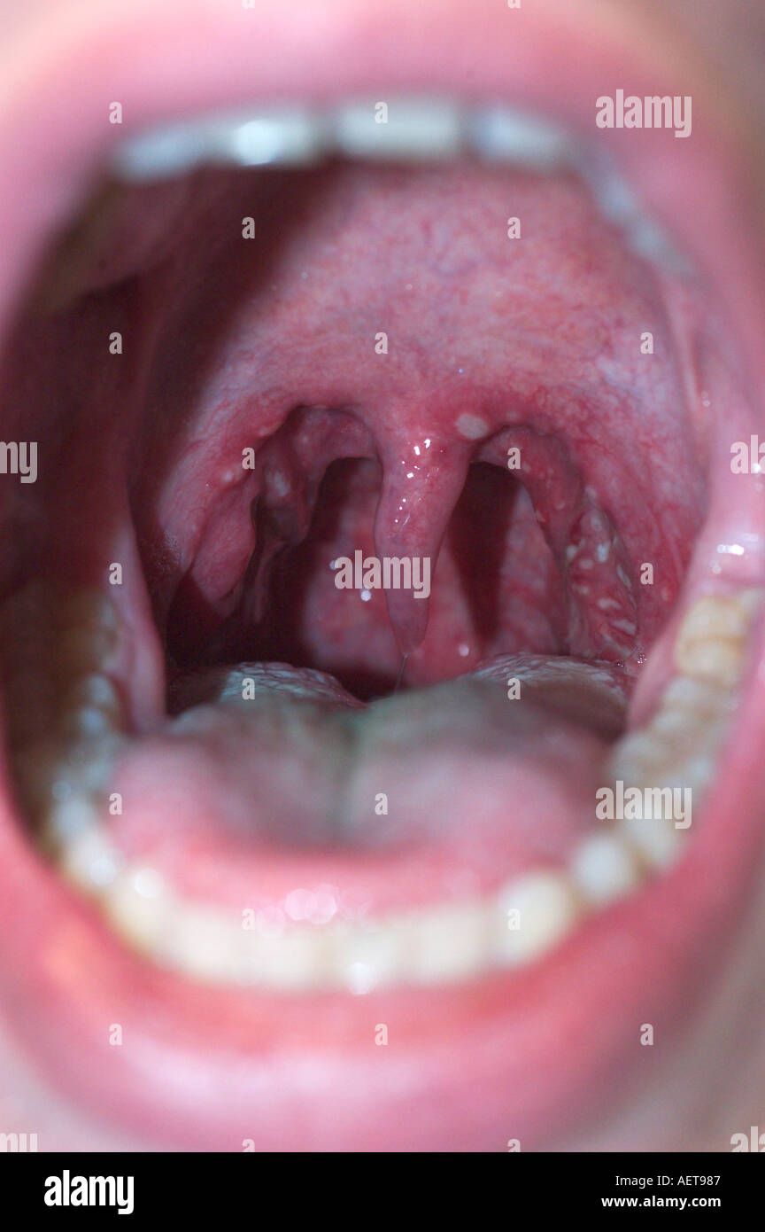 throat of a patient with pharyngitis sore throat Stock Photo