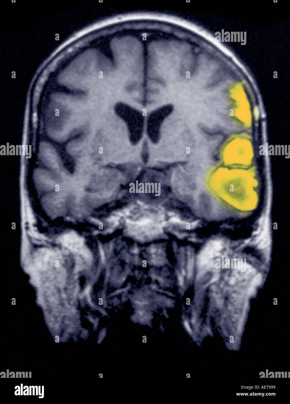 Temporoparietal brain hemorrhage in a 77 year old female ...
