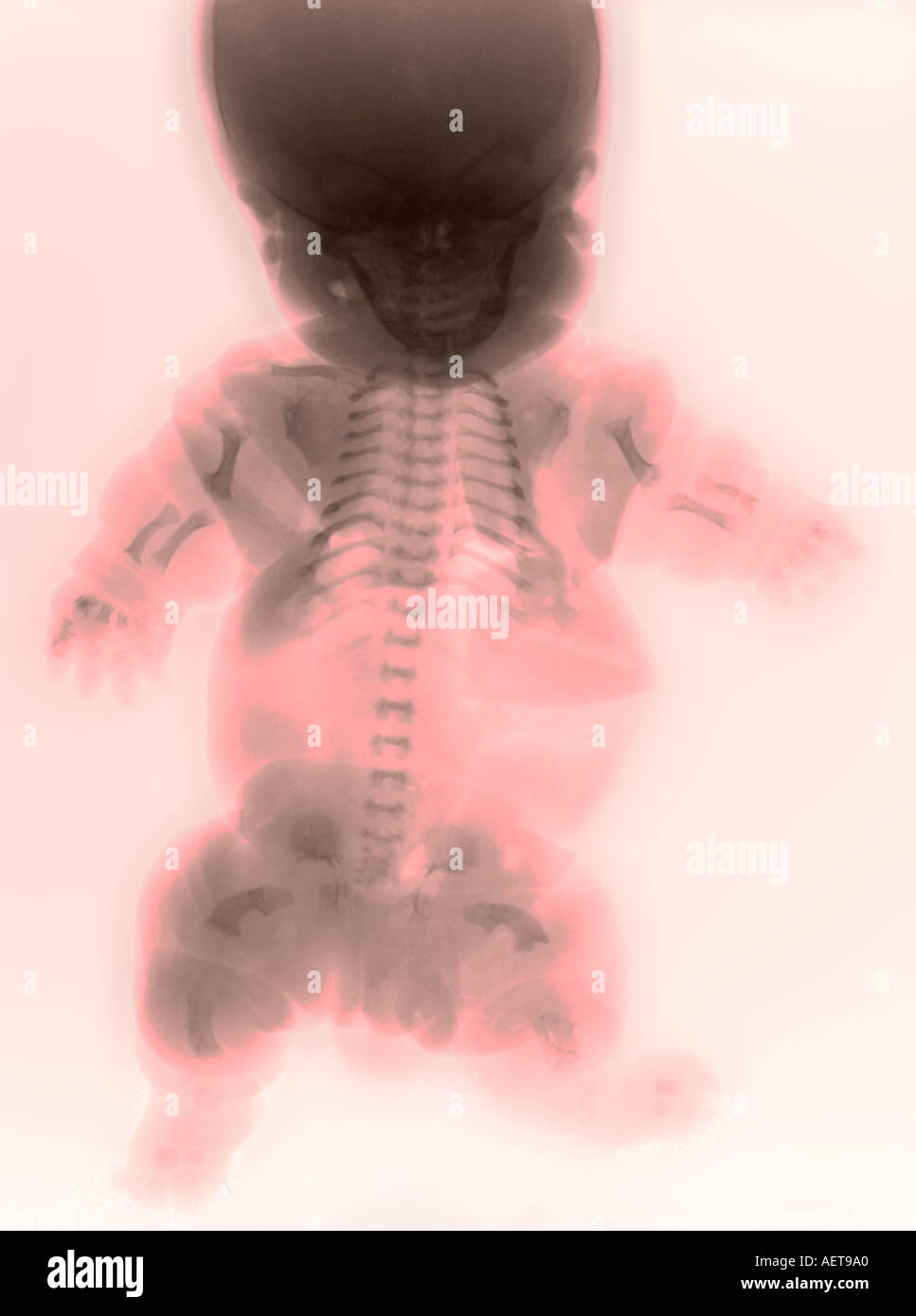 xray of a baby showing dwarfism Stock Photo