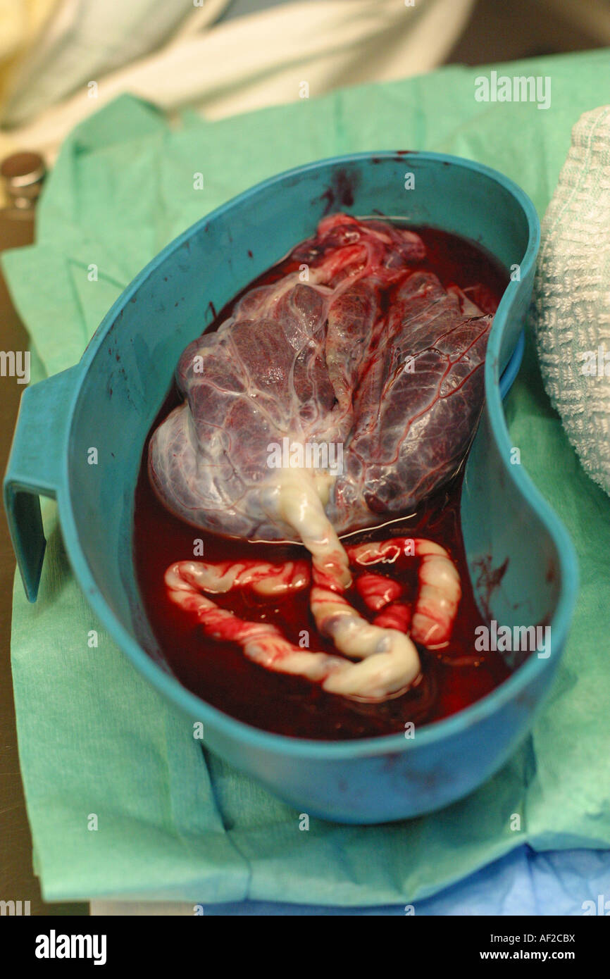 Placenta After Birth in a bowl in a Hospital Delivery Room minutes after a mother has given birth Stock Photo