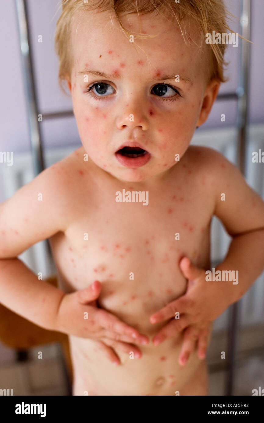 Boy with chicken pox Stock Photo