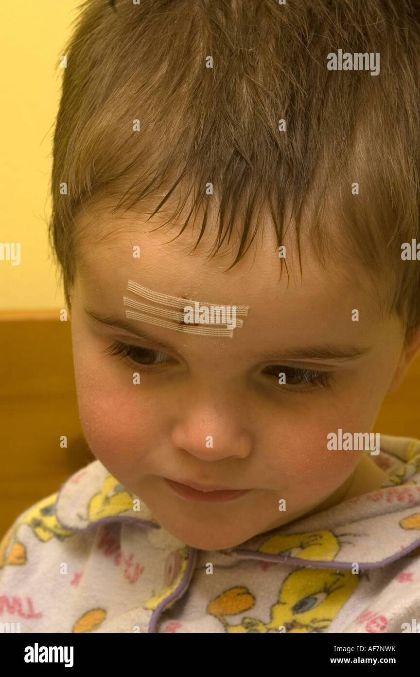 Little Boy With Butterfly Stitches In His Forehead Stock Photo Alamy