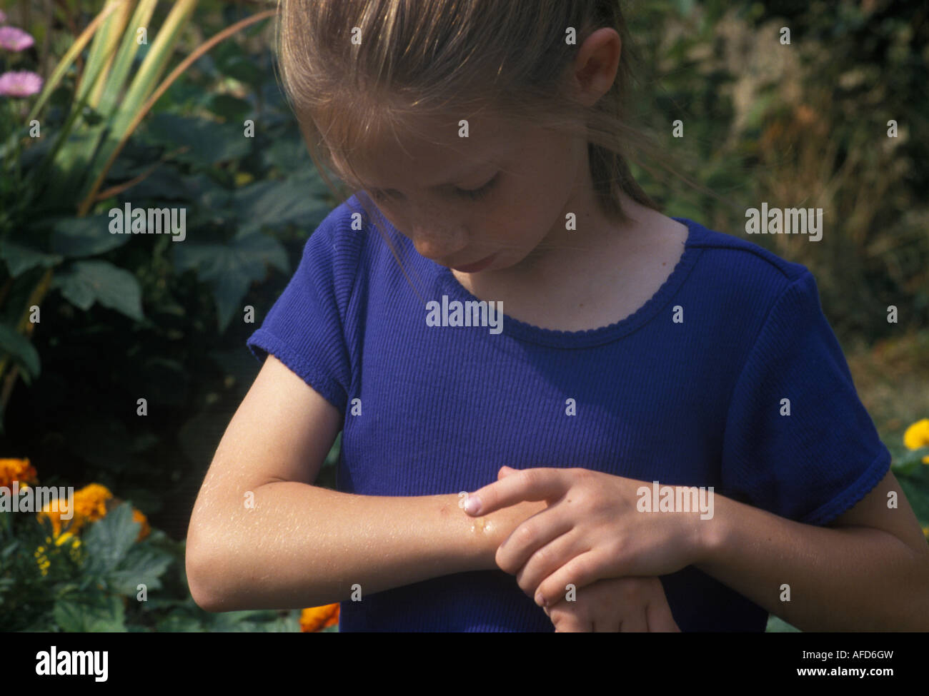 child with insect bite Stock Photo Alamy