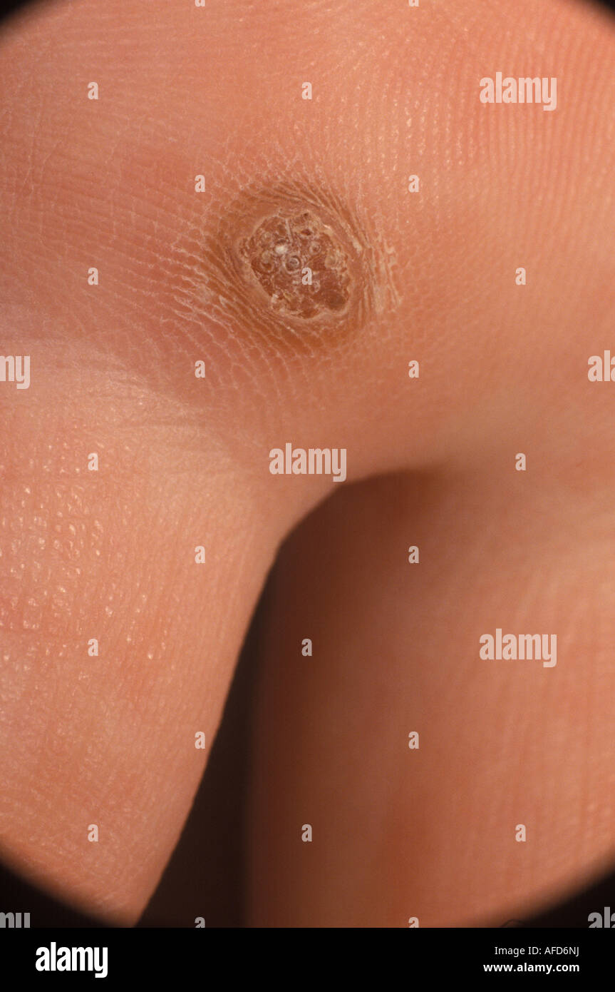 close up of a wart on the palm of a hand Stock Photo