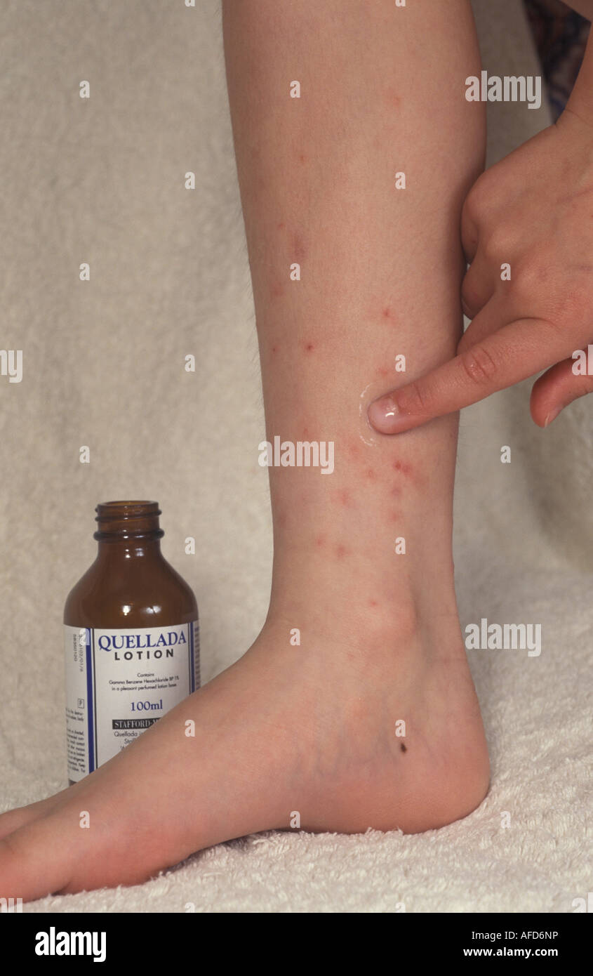 detail of person s leg with scabies Stock Photo