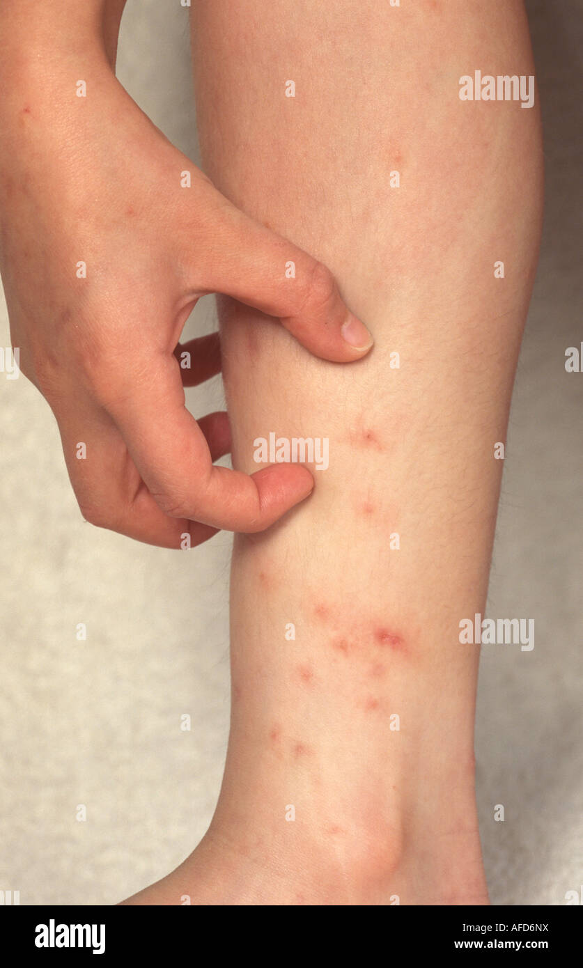 detail of hand scratching at leg with scabies Stock Photo