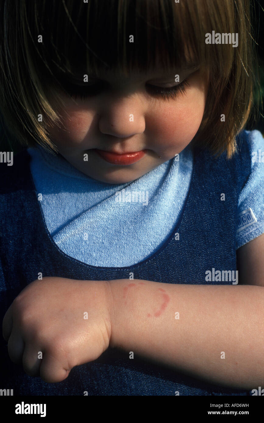 child looking at her arm where she has been bitten by another child Stock Photo