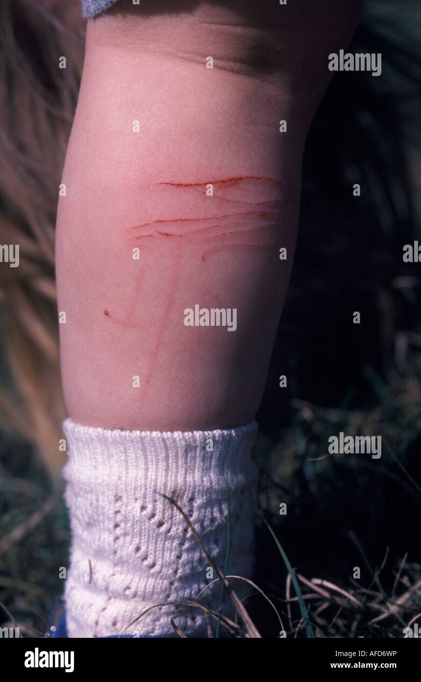 Lacerations leg hires stock photography and images Alamy