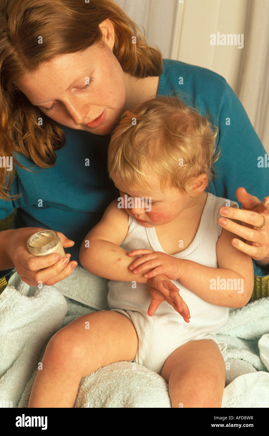 mother putting cream onto her child s eczema Stock Photo