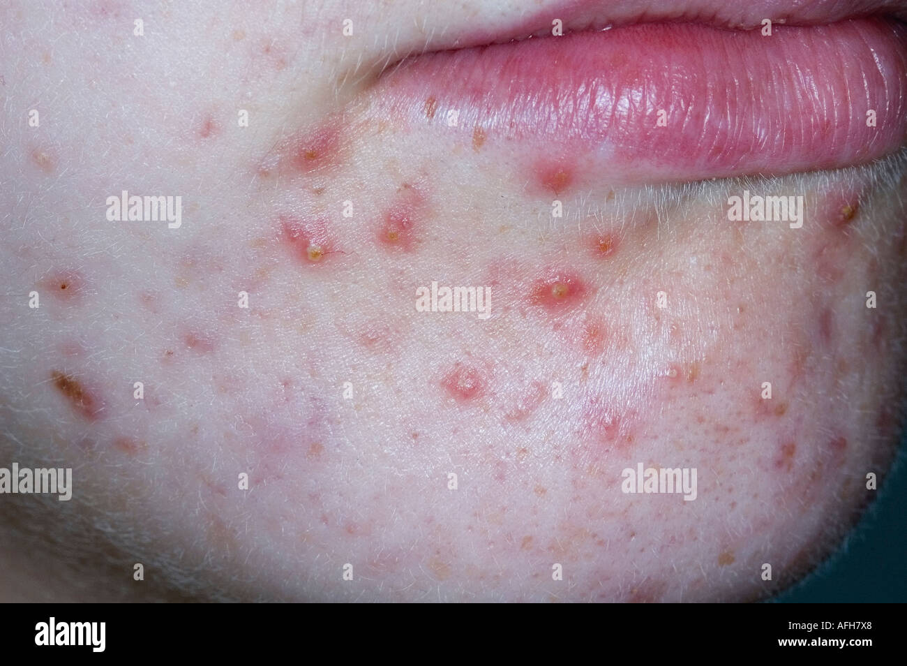 Acne Vulgaris of the chin Stock Photo 7970535 Alamy