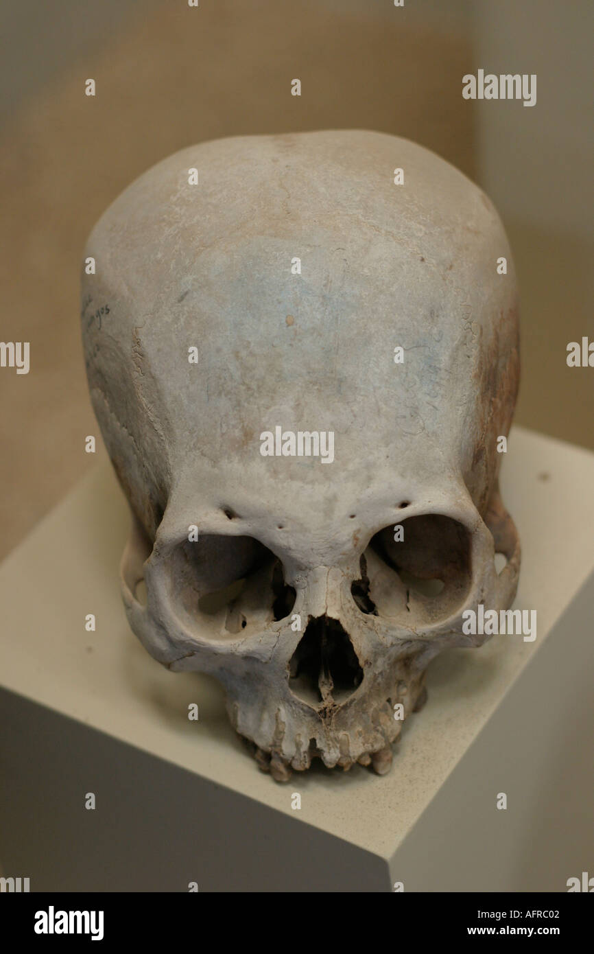 Human skull reshaped by trepaning Paraca pre Inca culture Cerro Colorado museum Peru Stock Photo