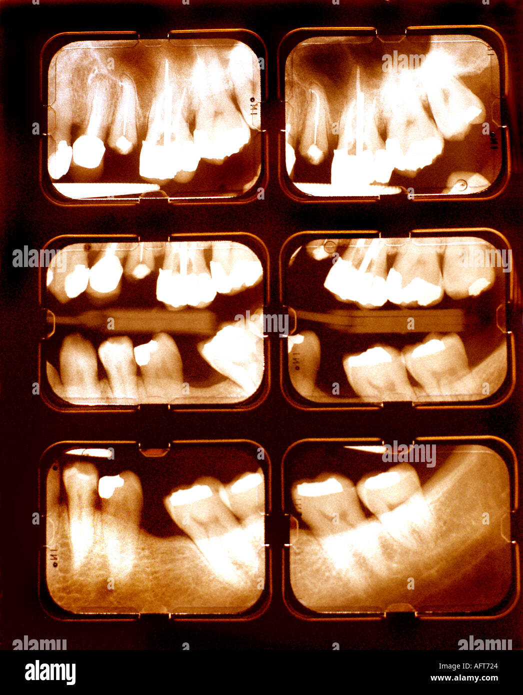 Medical Technology X Rays Dental Teeth Upper and Lower Mouth "Health Care costs" "Sepia Tone
