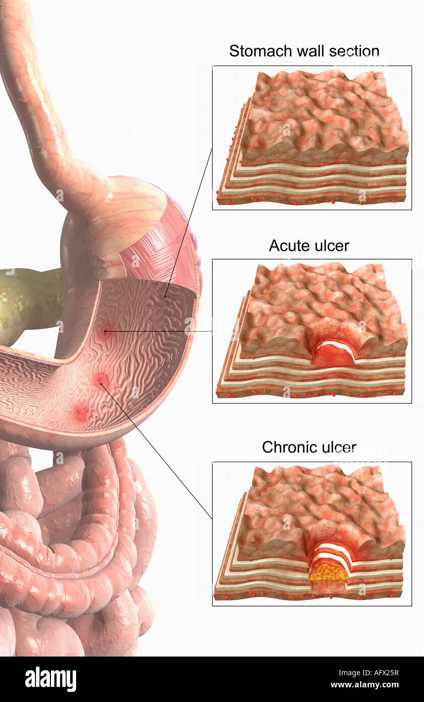 Stomach Ulcer Stock Photos & Stomach Ulcer Stock Images Alamy