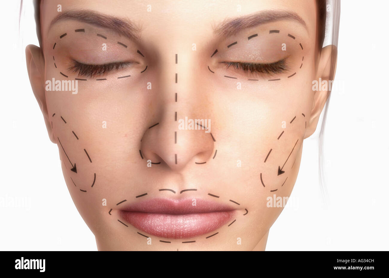 rhytidectomy