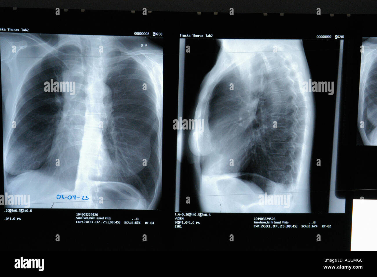 xray plate of human lungs, screening lung cancer Stock Photo Alamy