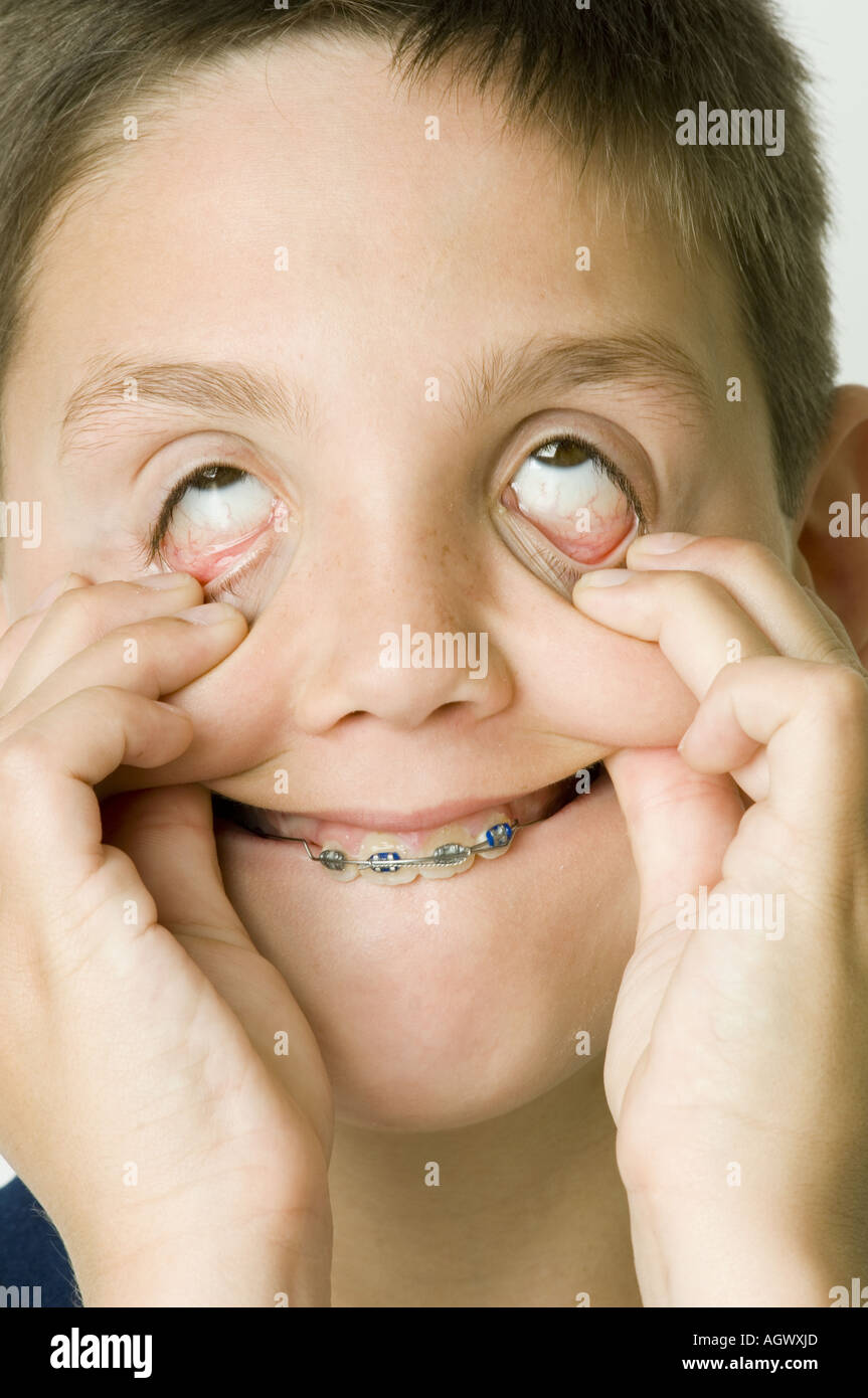 Caucasian boy making funny monster face and funny eyeballs at camera. Stock Photo