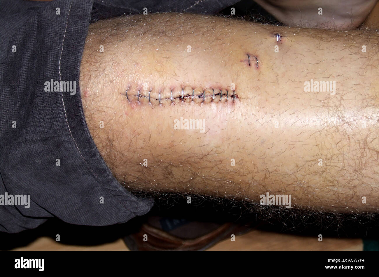Man, close-up of knee with metal staples following surgery to mend a broken tibea. Stock Photo