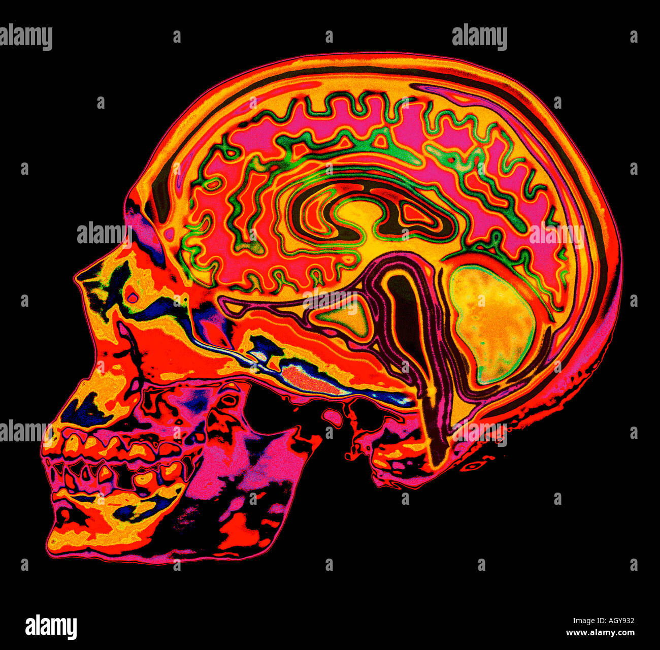 Skull mri hi-res stock photography and images - Alamy