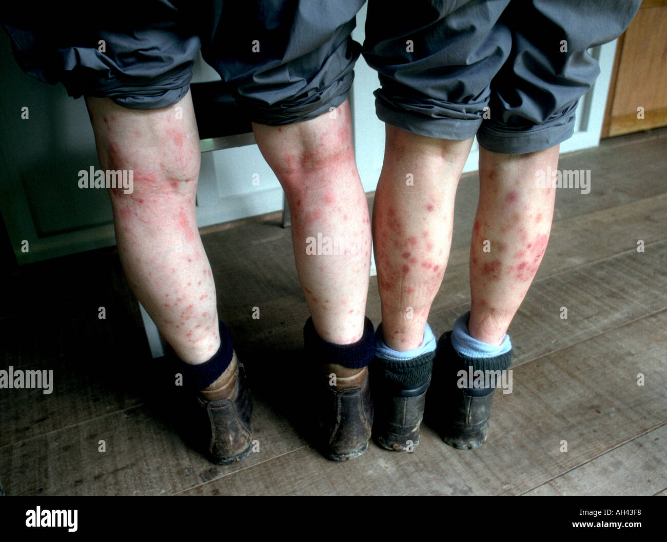 A male and female tourist in the amazon jungle with mosquito bites on
