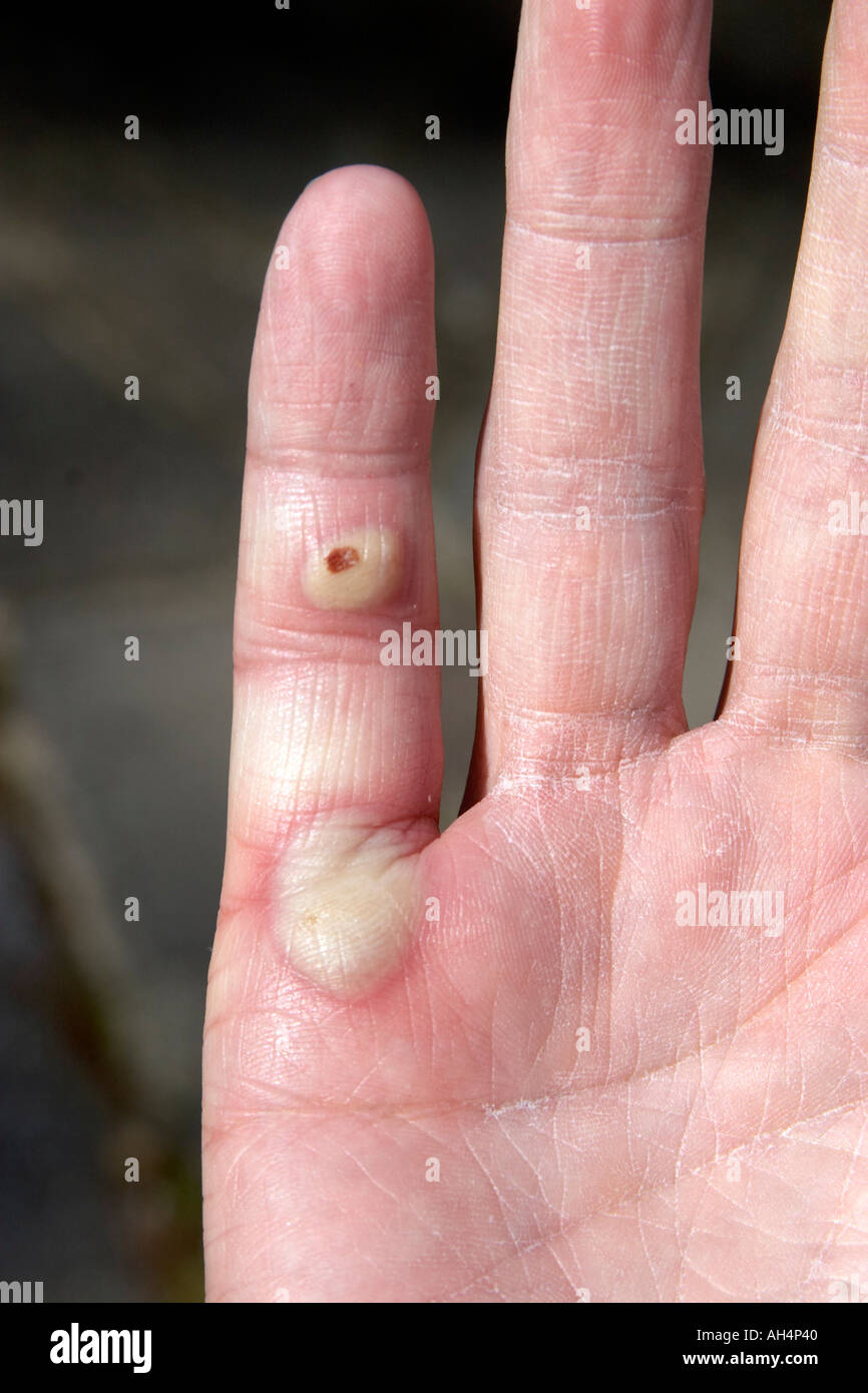 Male hand with injury of two large sore painful blisters Stock Photo