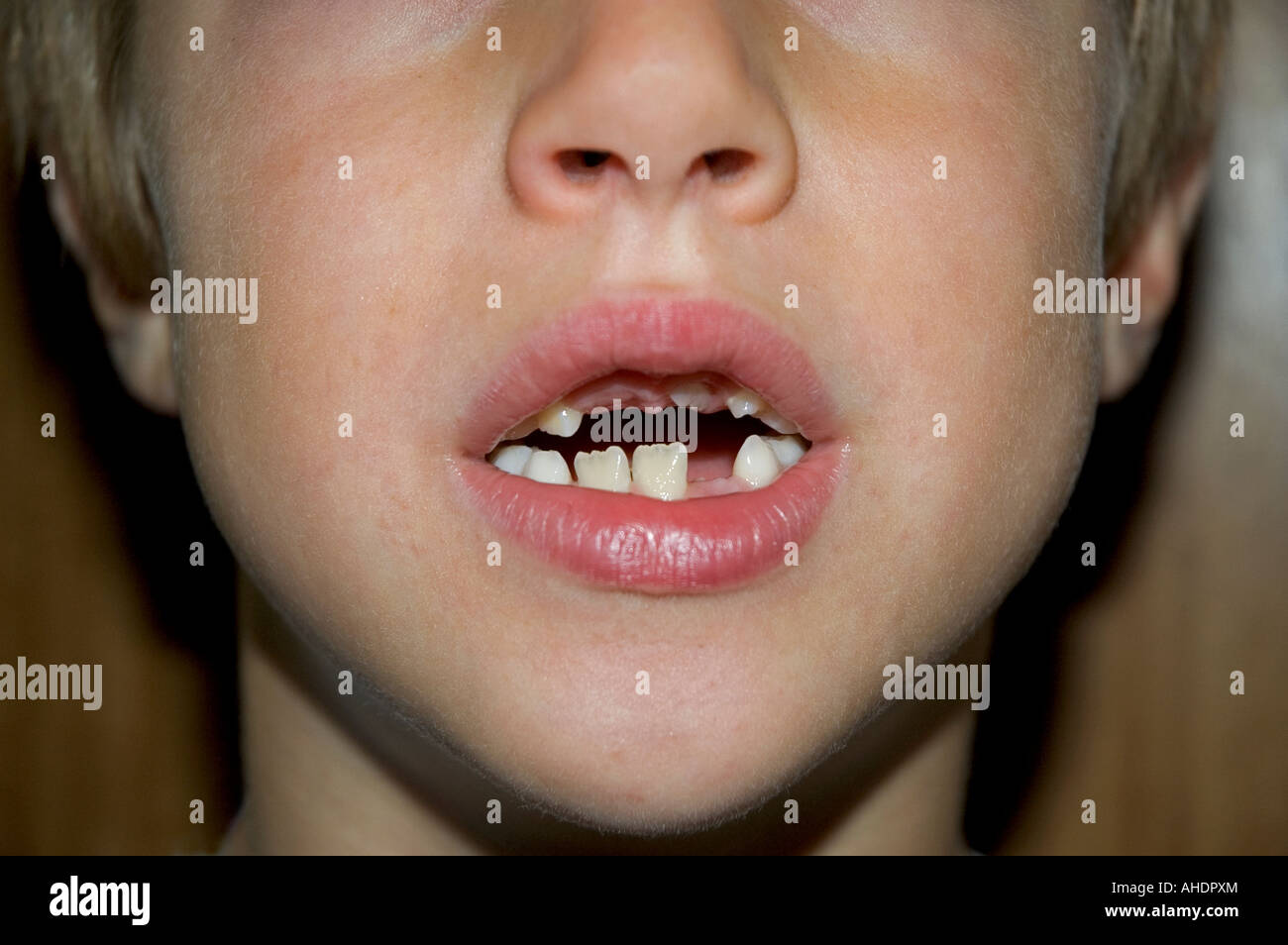 a young boy with his mouth open showing missing teeth Stock Photo