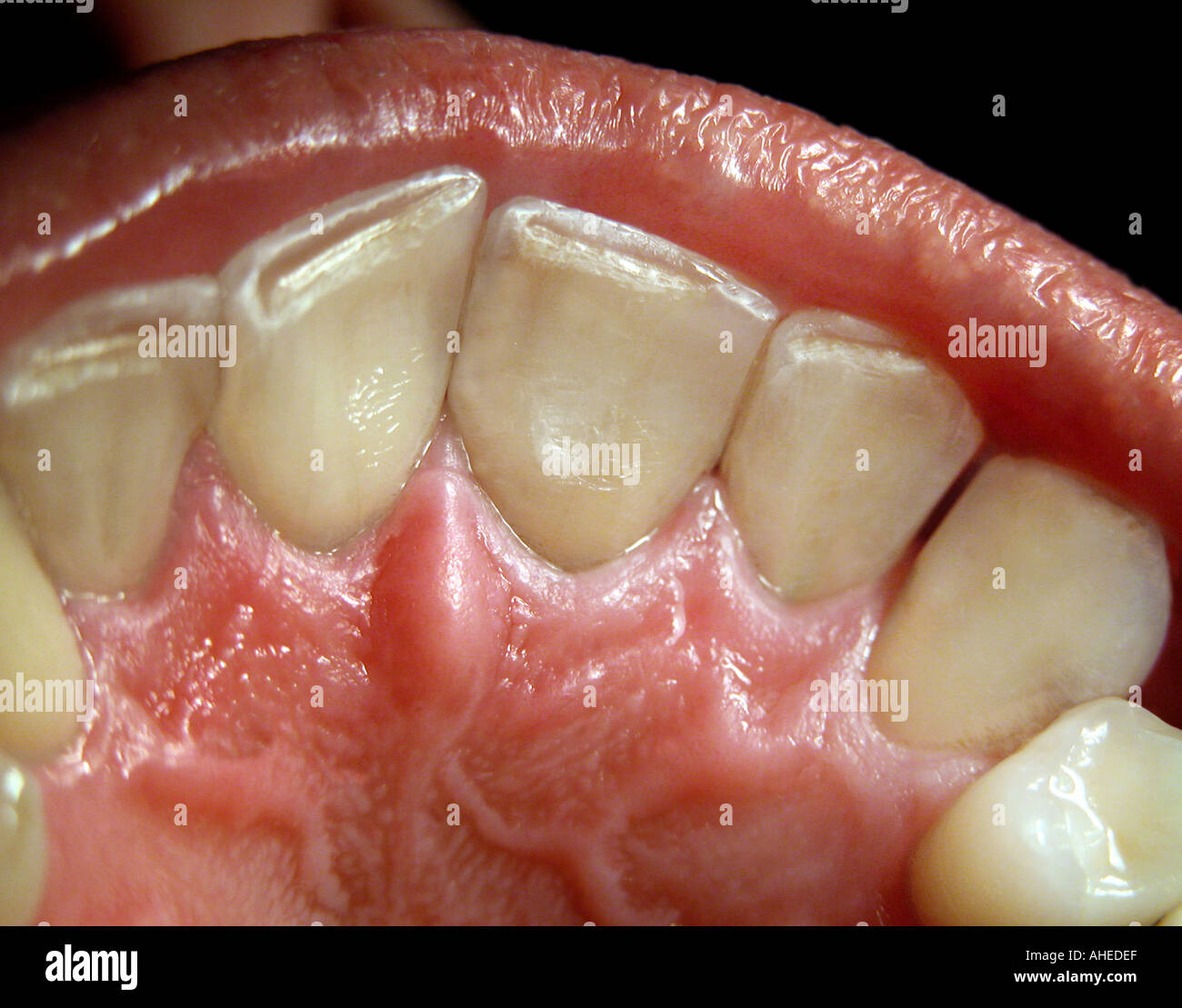 Rows Of Teeth Stock Photos & Rows Of Teeth Stock Images - Alamy