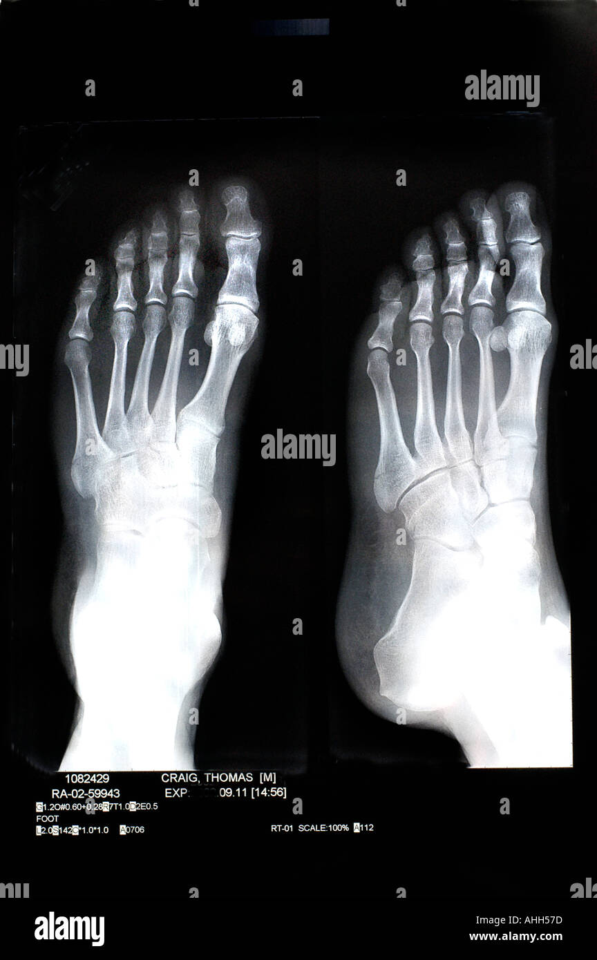 Medical "X Rays" of BRoken Bones in "Left Foot" xray "Black and Stock