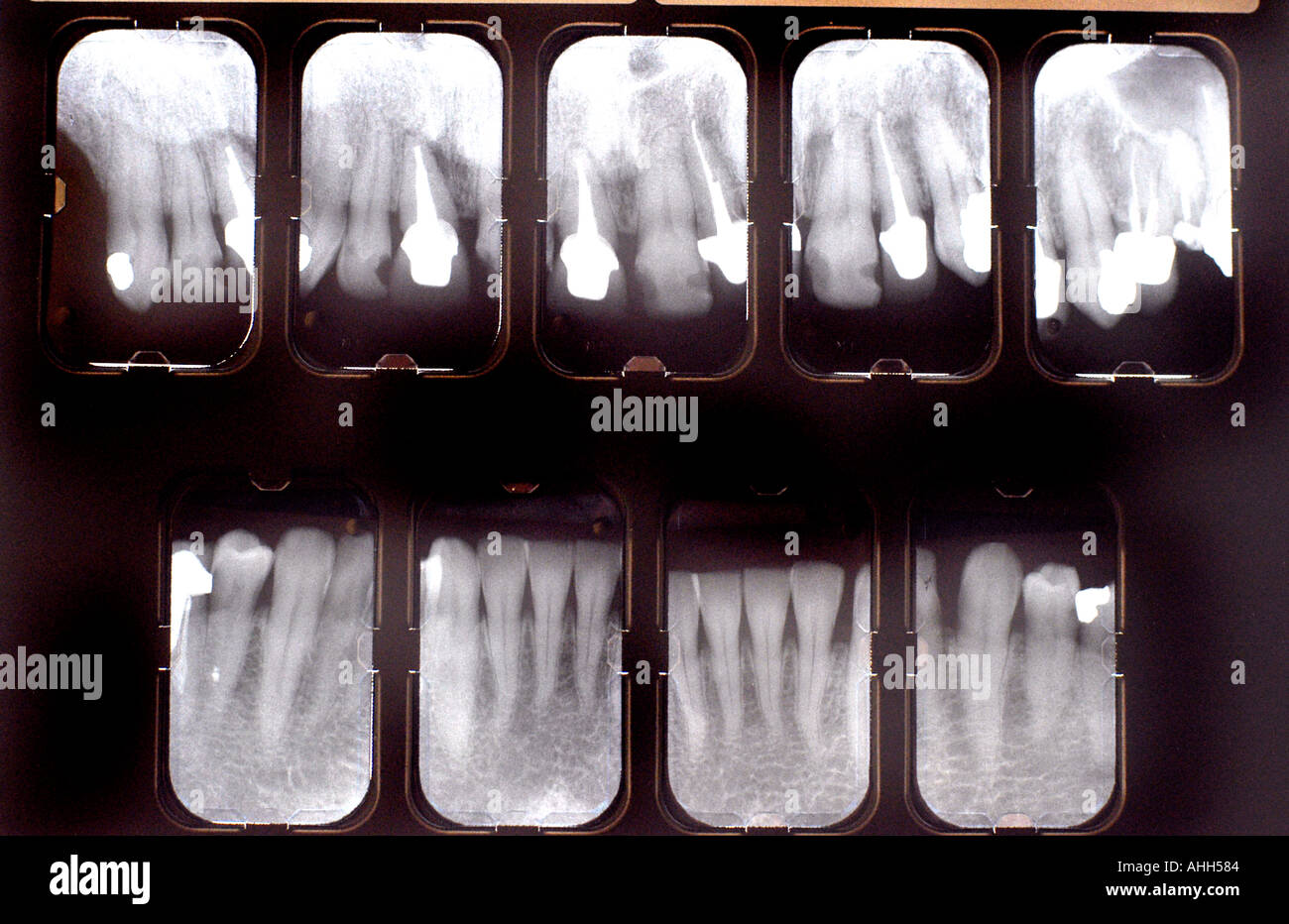 Medical Dental X Rays of Teeth Upper and Lower Mouth Health Care xray "Dental Care Stock Photo