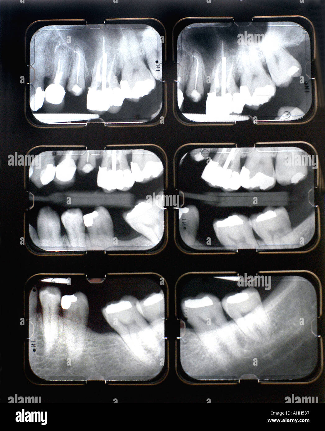 Teeth Xray Stock Photos & Teeth Xray Stock Images Alamy