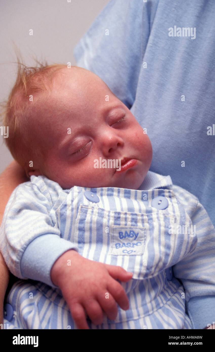 newborn baby with Downs Syndrome disease Stock Photo ...