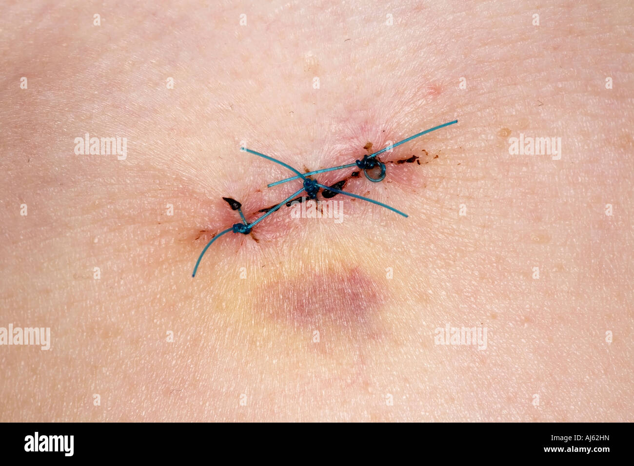 Medical stitches hi-res stock photography and images - Alamy